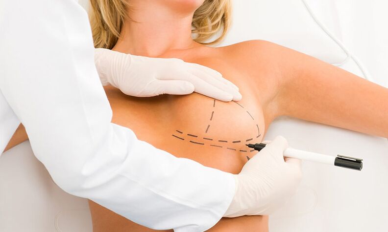 Oznaczanie piersi Mammoplasty