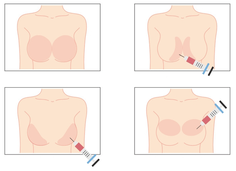 Miejsca wstrzykiwania kwasu hialuronowego do piersi