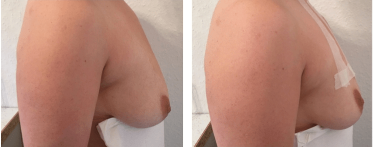 Przed i po liftingu piersi nitkami