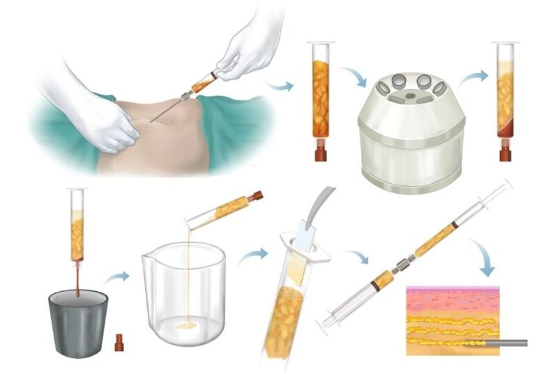 Usunięcie tłuszczu z obszarów problemowych, obróbka i wstrzyknięcie do tkanki piersi