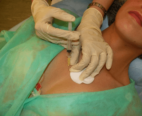 Wprowadzenie mezo-koktajlu do tkanki piersi - alternatywa dla zastrzyków z kwasu hialuronowego