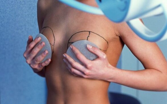 powiększanie piersi implantami